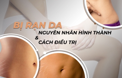 Nguyên nhân và hướng điều trị vết rạn trắng an toàn