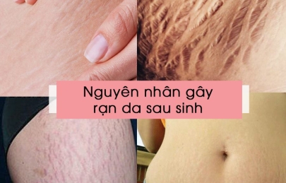 Vết rạn da sau sinh bị ngứa – nguyên nhân và cách điều trị ngứa rạn da sau sinh