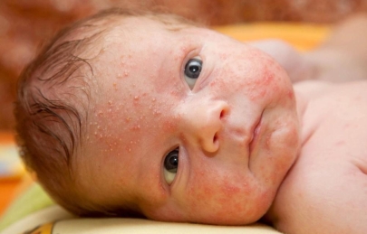 10 loại lá tắm cho trẻ sơ sinh bị rôm sảy