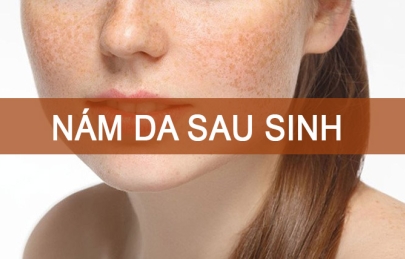 [Mách bạn] cách trị nám sau sinh không lo tái phát hiệu quả an toàn cho mẹ bỉm sữa