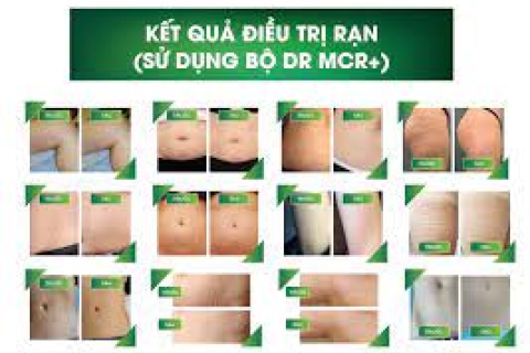 Điều trị Rạn