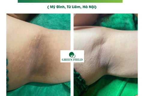 Điều Trị Thâm