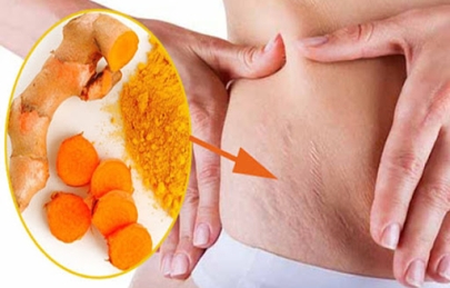 Tuyệt chiêu điều trị rạn da sau sinh bằng nghệ bạn có thể tin dùng- green