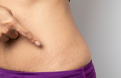 Bí kíp chăm sóc bụng rạn sau sinh cực kỳ hiệu quả