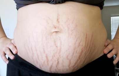 Điều trị rạn da sau sinh vào thời điểm nào thích hợp