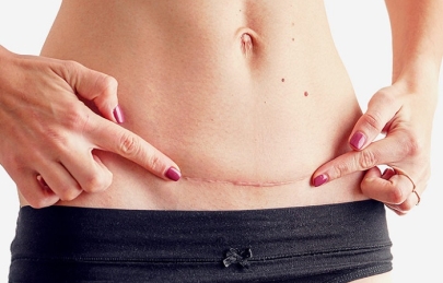 Cách chăm sóc khi vết mổ sau sinh bị cứng,ngứa ngáy