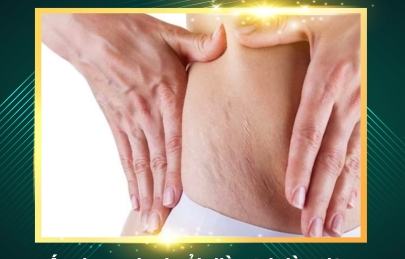  Trị rạn da giá bao nhiêu địa chỉ ở đâu tốt hiên nay ?