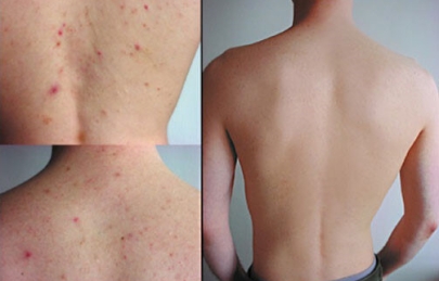 Làm sao để trị sẹo thâm thuỷ đậu trên da?