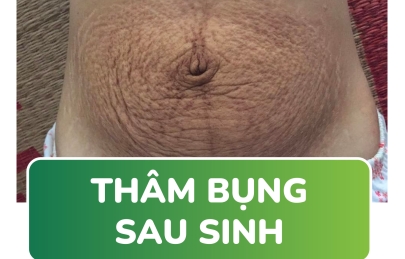 Thâm bụng sau sinh – thâm mấy cũng hết chỉ sau một đêm