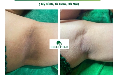 Tại sao lại thâm nách sau sinh ? điều trị thâm nách sau sinh như thế nào ?