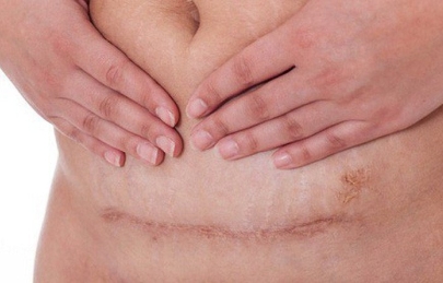 [Mách mẹ] Cách Chăm sóc vết mổ sau sinh không để lại sẹo hạn chế sẹo giúp sẹo liền và mờ hiệu quả