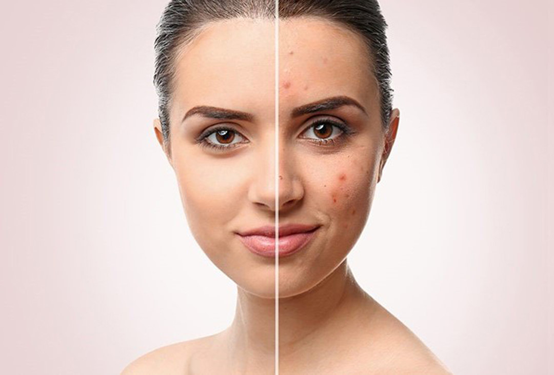 điều trị thâm da mặt tại Gree Field spa