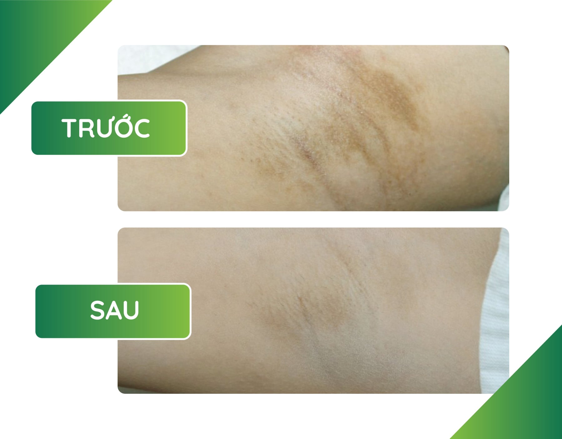 điều trị thâm nách sau sinh