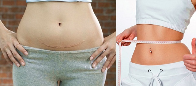 giảm cân sau sinh mổ