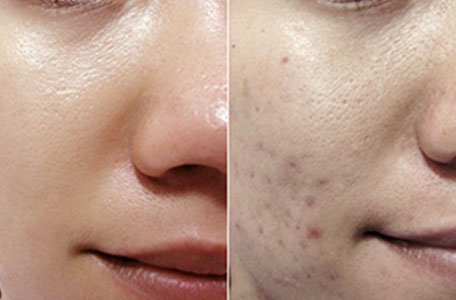 Dịch vụ điều trị thâm mụn cấp tốc tại Green Field spa