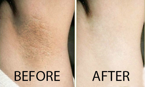 Dịch vụ điều trị thâm nách tại nhà của Green Field spa