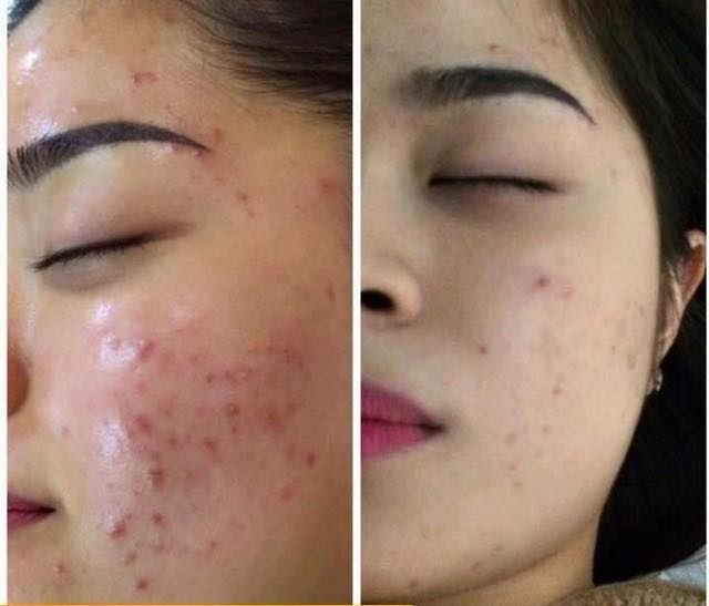 Điều trị mụn sau sinh an toàn,hiệu quả cao tại Green Field spa